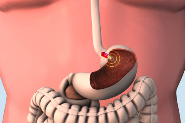 Capsule Endoscopy