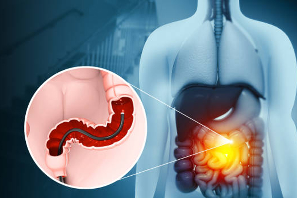 Colonoscopy