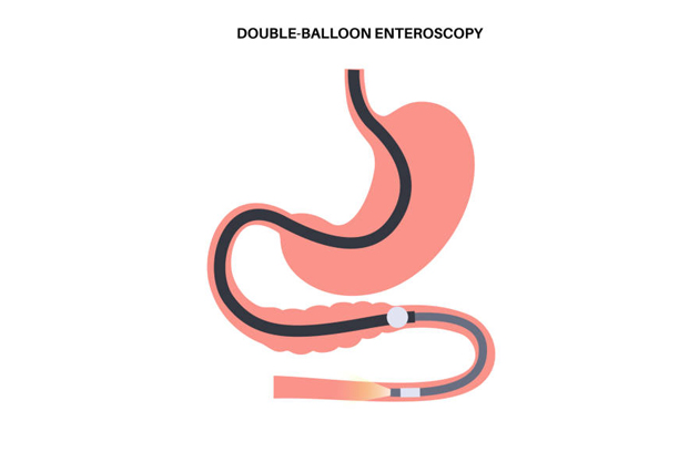 Double Balloon Enteroscopy