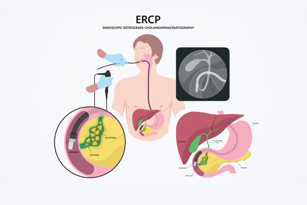 ERCP
